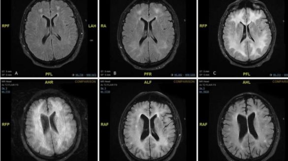 la-imagen-que-muestra-los-efectos-del-consumo-de-cocaina-en-el-cerebro