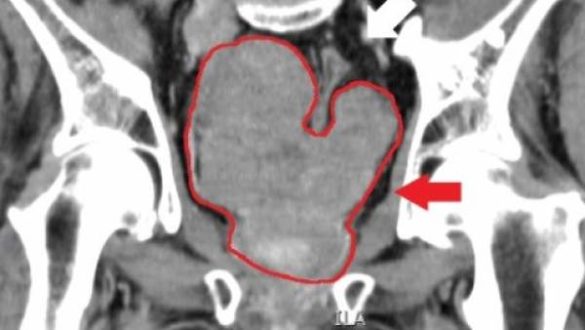 aplican-una-terapia-con-nanoparticulas-de-oro-que-destruye-el-cancer-de-prostata-sin-quimio-cirugia-o-radiacion