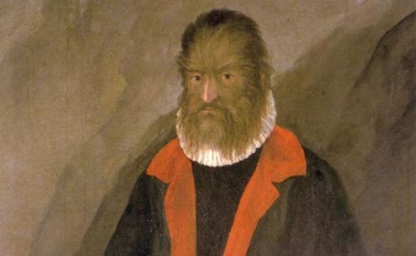 el-039sindrome-del-hombre-lobo039-causas-y-efectos-de-la-enfermedad-de-la-hipertricosis