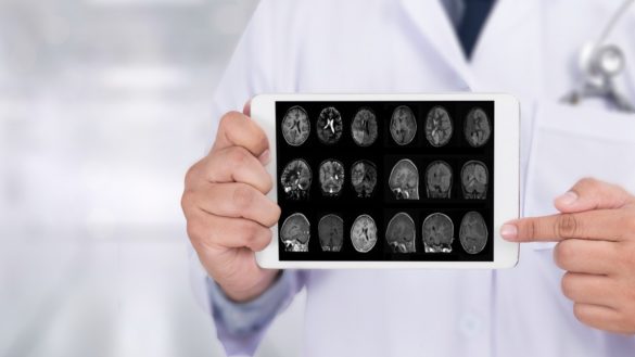 descubren-que-una-proteina-del-cerebro-retrasa-la-progresion-del-alzheimer