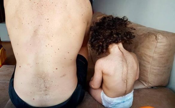 cuando-el-039sindrome-del-hombre-lobo039-lo-causan-los-genes