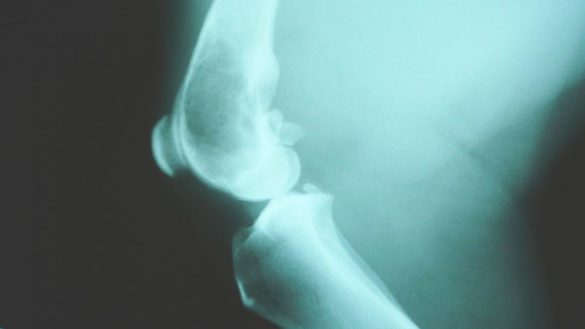 que-es-un-osteosarcoma-la-enfermedad-que-sufria-xana-la-hija-de-luis-enrique