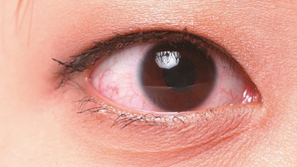 realizan-en-japon-el-primer-trasplante-de-cornea-con-celulas-madre-171reprogramadas187