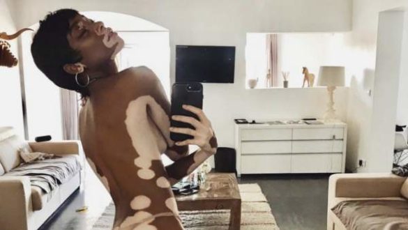lo-que-debes-saber-sobre-el-vitiligo-afecta-mas-a-la-mujeres-es-muy-comun-y-no-contagioso