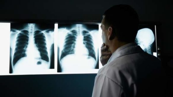 un-nuevo-tratamiento-reduce-el-cancer-de-pulmon-en-el-80-de-los-pacientes