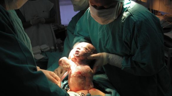 los-bebes-que-nacen-por-cesarea-tienen-mas-bacterias-que-pueden-causar-enfermedades