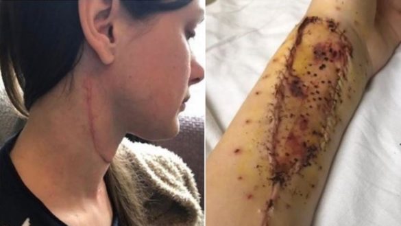reconstruyen-su-lengua-con-musculos-del-brazo-tras-una-cirugia-de-11-horas