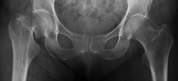 Radiografía de cadera