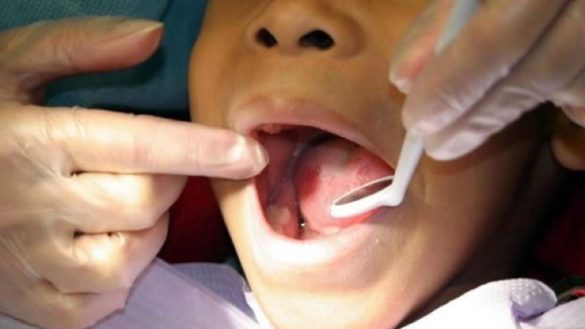 los-adultos-a-los-que-les-faltan-dientes-pueden-tener-mas-riesgo-de-sufrir-una-enfermedad-cardiovascular