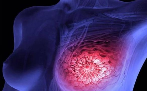 demuestran-la-efectividad-de-la-tecnologia-protac-contra-el-cancer-de-mama