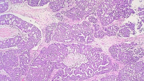 un-estudio-ofrece-una-hipotesis-sobre-las-causas-y-posibles-soluciones-del-cancer-de-ovario