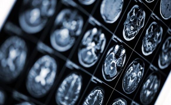 gobierno-y-autonomias-aprueban-el-primer-plan-nacional-contra-el-alzheimer