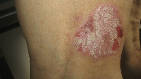 la-gravedad-de-la-psoriasis-esta-relacionada-con-la-gravedad-de-la-enfermedad-del-higado-graso