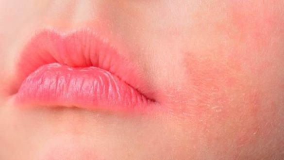 la-rosacea-causas-sintomas-y-cura-de-una-afeccion-dermica-que-padecen-42-millones-de-espanoles