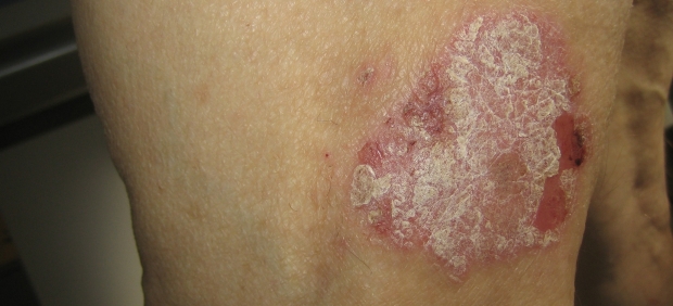 Psoriasis
