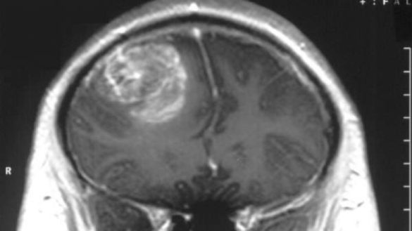 descubren-un-mecanismo-celular-implicado-en-el-tumor-cerebral-mas-letal