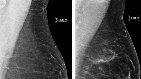 la-prediccion-del-riesgo-del-cancer-de-mama-da-un-paso-mas-gracias-a-la-inteligencia-artificial
