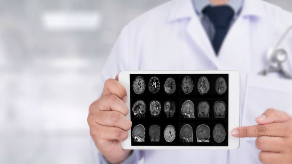 investigadores-descubren-que-el-alzheimer-se-activa-por-una-senalizacion-defectuosa-de-la-noradrenalina