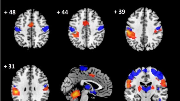demuestran-que-las-hernias-cervicales-generan-danos-importantes-en-el-cerebro