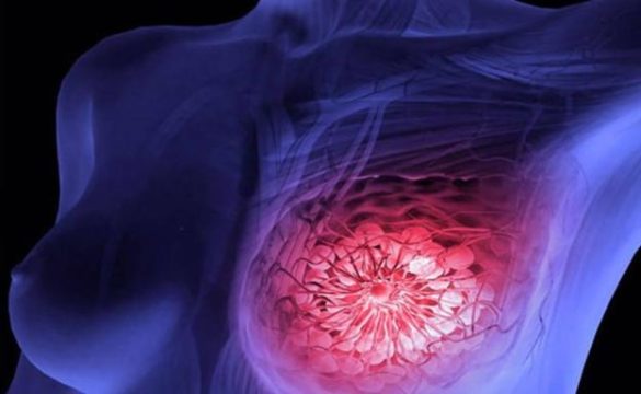 el-cancer-le-cuesta-a-los-espanoles-19.300-millones-de-euros-al-ano