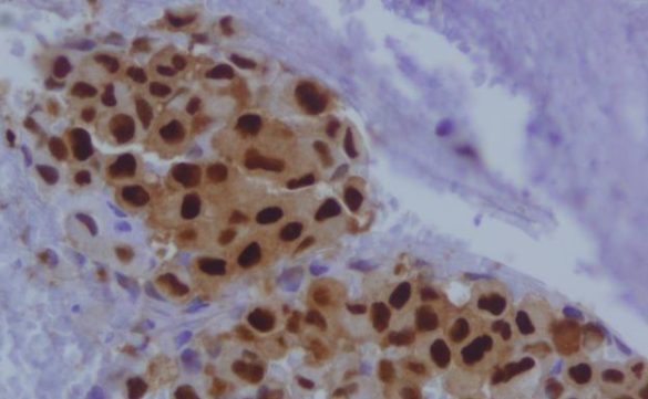 un-estudio-sin-precedentes-abre-la-posibilidad-de-detectar-el-cancer-antes-de-que-aparezca