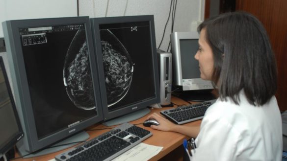 haber-sufrido-cancer-de-mama-aumenta-la-predisposicion-a-desarrollar-un-cancer-ginecologico