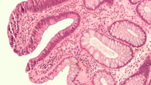 un-nuevo-farmaco-inteligente-acaba-con-las-celulas-de-la-metastasis-de-manera-selectiva