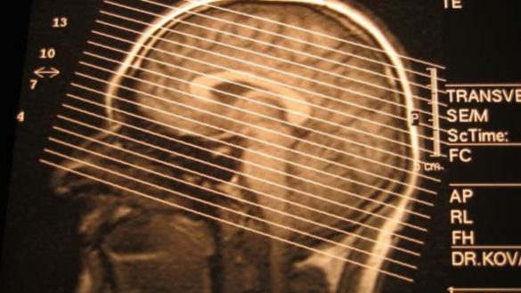 una-resonancia-ayuda-a-pronosticar-la-eficacia-de-una-operacion-de-epilepsia