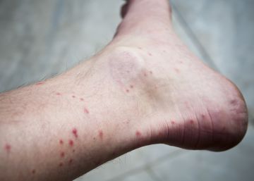 por-que-los-mosquitos-se-ceban-con-nuestros-tobillos