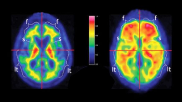 la-dieta-baja-en-carbohidratos-puede-prevenir-y-revertir-los-efectos-de-la-edad-en-el-cerebro