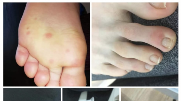 detectadas-lesiones-dermatologicas-en-los-pies-de-ninos-y-adolescentes-con-coronavirus