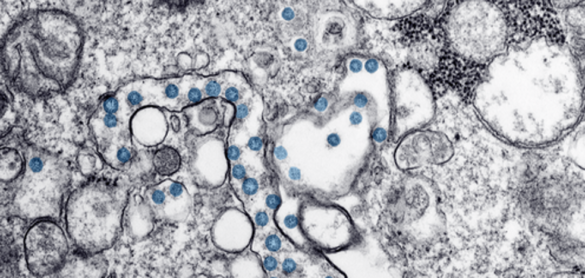 la-8216misteriosa8217-proliferacion-de-trombos-en-los-enfermos-de-covid-19