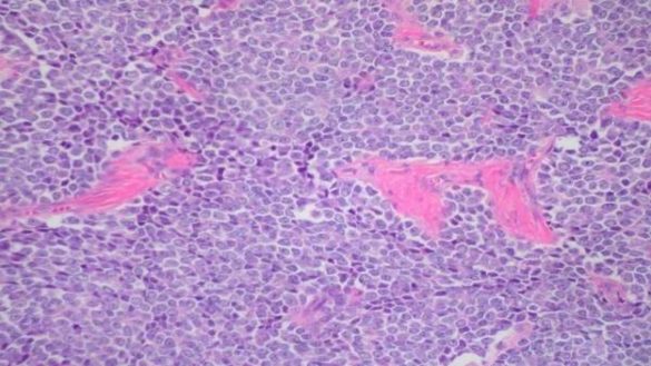 que-es-el-sarcoma-de-ewing