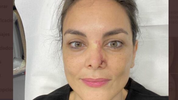 como-detectar-a-tiempo-un-cancer-de-piel-como-el-de-monica-carrillo