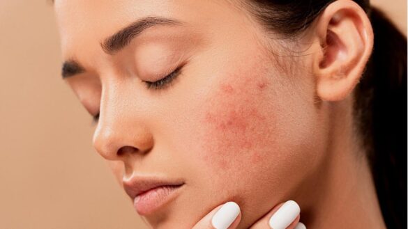 ¿afectan-los-alimentos-grasos-al-acne?-mitos-y-verdades