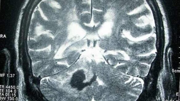 las-mujeres-tienen-hasta-un-40%-mas-de-muerte-tras-un-accidente-cerebrovascular,-segun-un-estudio