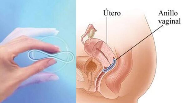 anillo-vaginal,-preguntas-y-respuestas