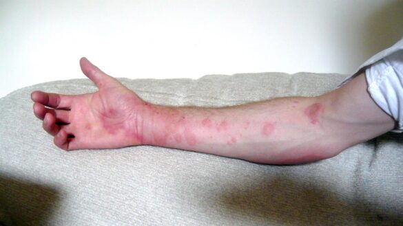 urticaria-por-frio,-que-es-y-como-tratarla