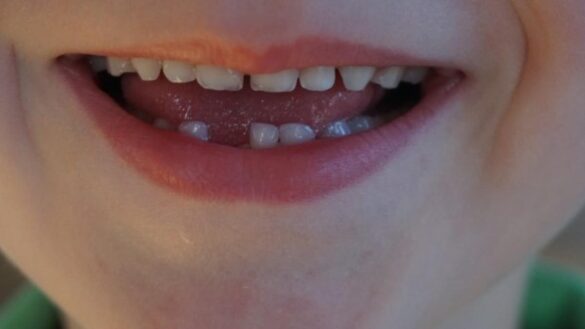 ¿se-deben-arrancar-los-dientes-de-leche-tambaleantes?