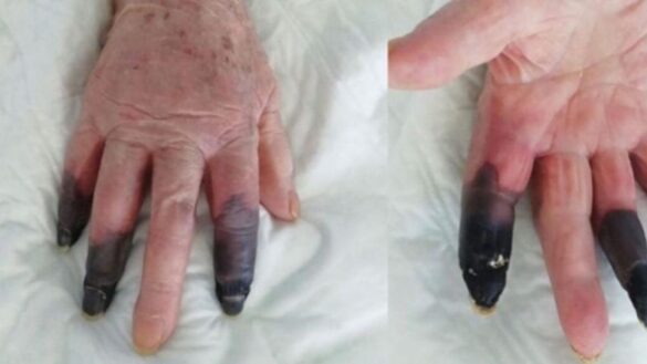 amputan-tres-dedos-a-una-mujer-tras-sufrir-lo-que-denominan-‘covid-fingers’:-la-secuela-que-provoca-gangrena