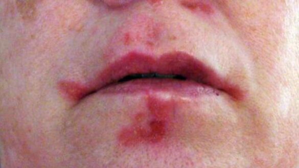 las-plaquetas-pueden-jugar-un-papel-clave-en-el-desarrollo-del-lupus,-segun-un-estudio