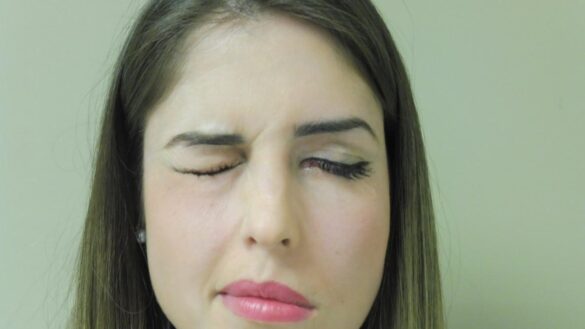 paralisis-facial-por-estres:-que-es-y-como-identificarla-a-tiempo