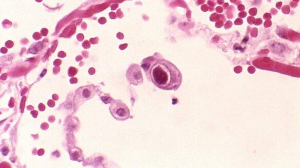 ¿que-es-el-citomegalovirus-y-que-complicaciones-tiene?