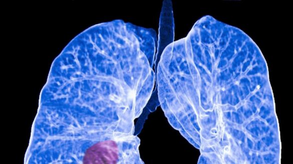 alertan-de-que-la-muerte-por-cancer-de-pulmon-en-mujeres-ha-subido-el-6,5%-en-los-ultimos-cinco-anos