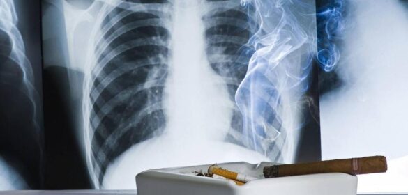 alertan-del-aumento-de-muertes-por-cancer-de-pulmon-entre-las-mujeres