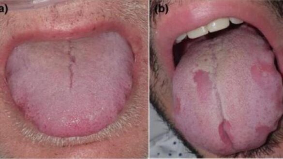nuevos-sintomas-de-la-covid-19:-aumento-de-la-lengua,-halitosis…