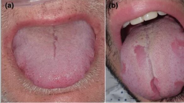 nuevos-sintomas-de-la-covid-19:-aumento-de-la-lengua,-halitosis-e-inflamacion-de-la-mucosa-oral