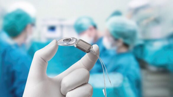 implantes-cocleares.-¿quien-puede-usarlos?-¿como-es-la-cirugia?-¿cuanto-se-tarda-en-oir-correctamente?