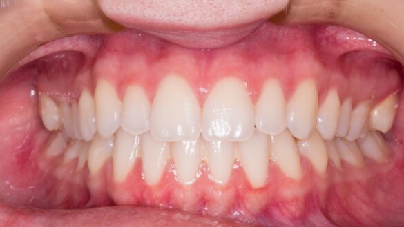 que-es-la-gingivitis:-causas,-sintomas-y-tratamiento