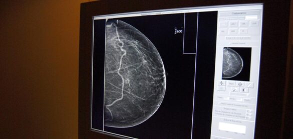 descubren-la-combinacion-de-dos-farmacos-para-combatir-el-cancer-de-mama
